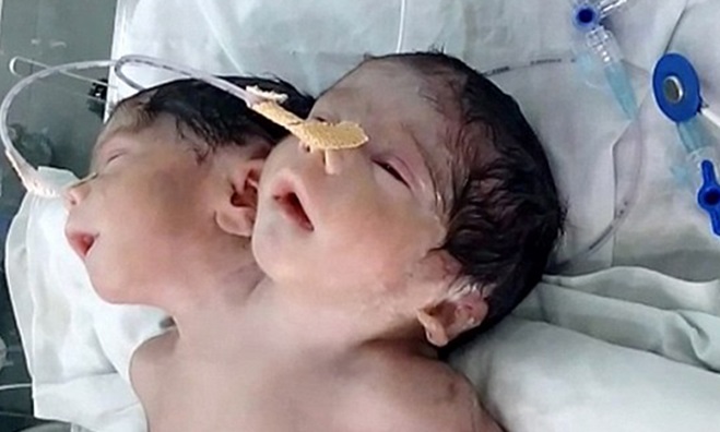 جراحی موفقیت‌آمیز نوزاد دو سر در هندوستان