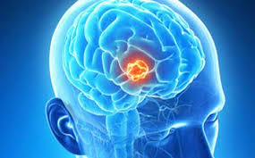 علت اصلی ابتلا به سرطان مغز کشف شد!