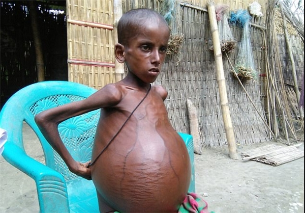 بیماری عجیب پسر ۷ ساله هندی+تصویر