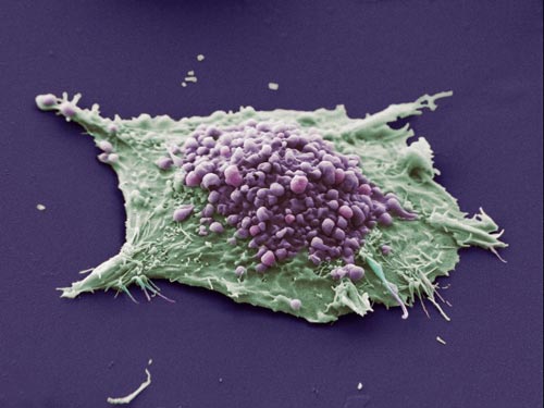 کشف روش نوین سلول های سرطانی