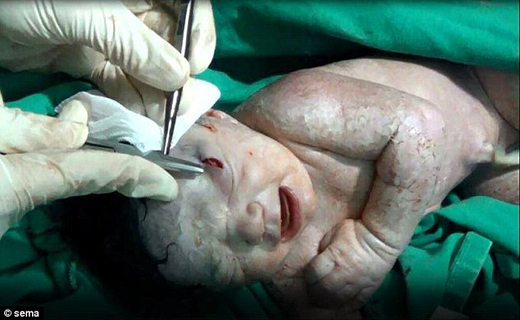 نجات نوزادی که قبل از به دنیا آمدن مجروح بود+ تصاویر