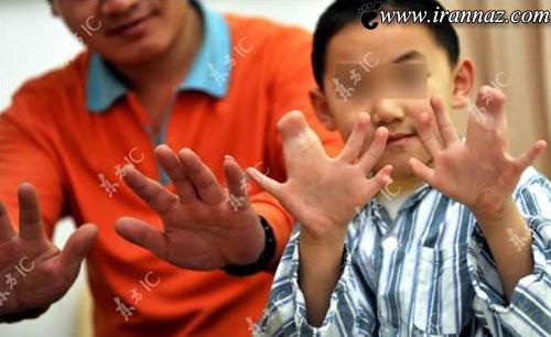 پسر شش ساله عجیبی که 30 انگشت دارد +عکس