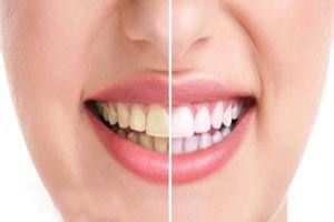 چگونه از زرد شدن دندان ها جلوگیری کنیم؟