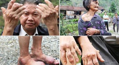 بیماری عجیب در میان افراد روستایی در چین +عکس