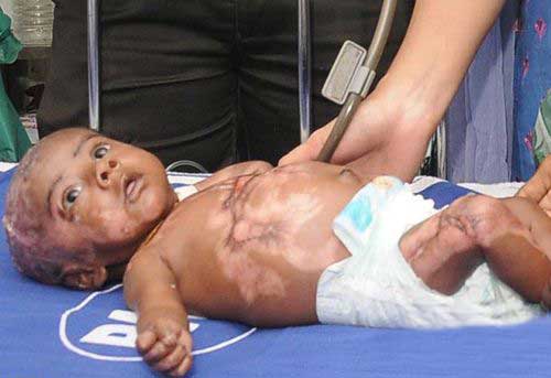 بدن این کودک بدون هیچ دلیلی خودسوزی می کند +عکس