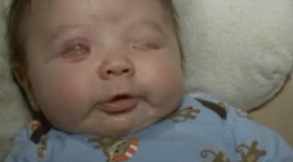 نوزاد زیبایی که بدون چشم متولد شد +عکس