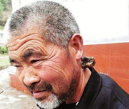 این مرد چینی روی گردنش شاخ دارد +عکس