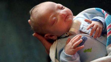 نوزادی که بینی ندارد +عکس
