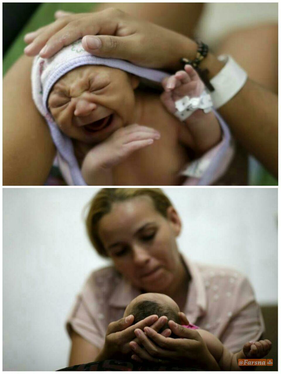 دختری مبتلا به میکروسفالی در آغوش مادر برزیلی اش