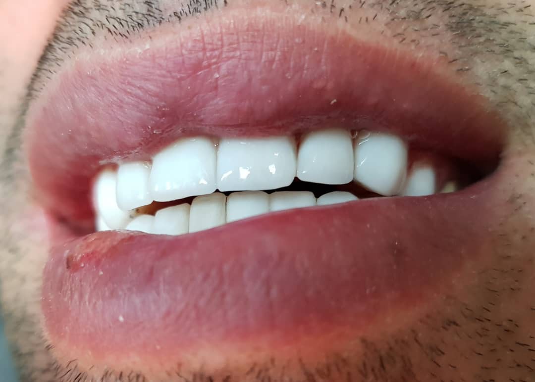 چرا پس از لمینت دندان، دندان درد می‌گیریم؟!