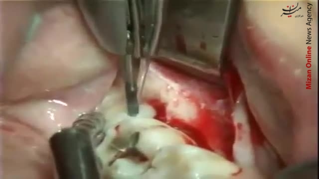 چرا باید دندان عقل را جراحی کنیم؟(گزارش55)