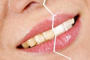 زردی دندان هایتان را به کمک فویل آلومینیوم محو کنید (گزارش60)