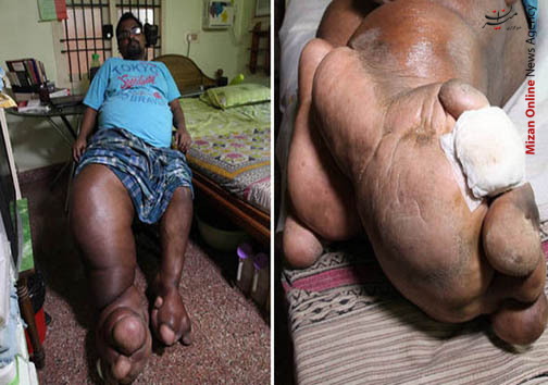بیماری عجیب و غریب مرد هندی +تصاویر