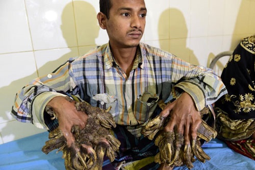 مرد درختی بنگلادش چطور عمل شد؟/امید به زندگی عادی پس از جراحی سخت