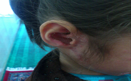 خانه‌نشینی دختربچه ۷ ساله براثر بیماری +عکس