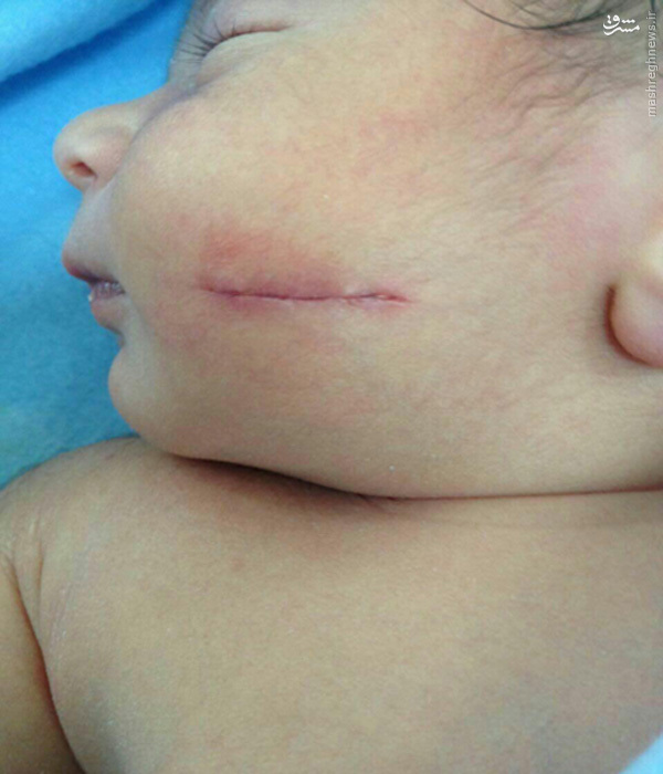 تیغ پزشک بر صورت نوزاد +عکس