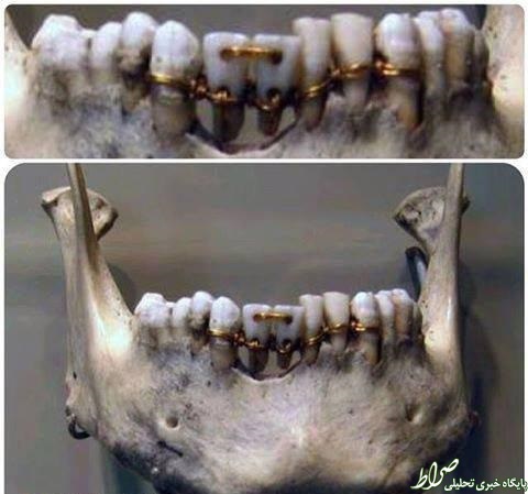 دندان‌های ترمیم شده 4000 سال پیش +تصاویر