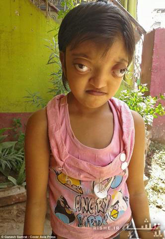بیماری نادر یک دختر بچه +تصاویر