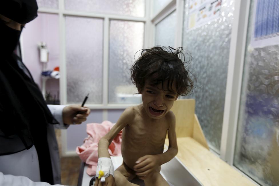 تصاویر/ آثار تکان دهنده سوء‌تغذیه بر کودکان یمنی