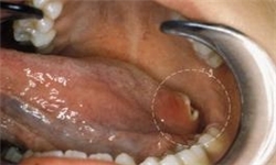 شیوع سرطان حفره دهان در ایران/ علائم و نشانه‌های بیماری