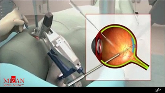 موفقیت اولین جراحی چشم با ربات + فیلم