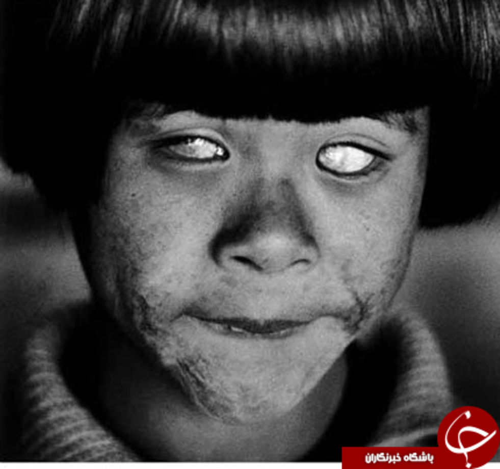 درخشان‌تر از هزاران خورشید

این تصویر وحشتناک و غم انگیز دختربچه‌ای را نشان می‌دهد که از بمب اتم هیروشیما در ۶ آگوست ۱۹۴۵ جان سالم به در برده، اما چشمانش را از دست داده است. این بمباران حدود ۹۰ تا ۱۴۶ هزار نفر را در هیروشیما کشت.