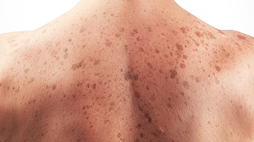 افرادی که پوست روشن دارند بیشتر به سرطان پوست مبتلا می شوند/ خطرناکترین نوع سرطان پوست را بشناسید