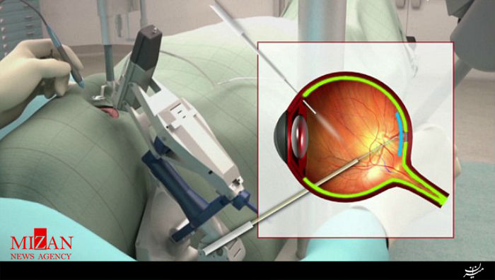 اولین جراحی چشم با کمک ربات در انگلستان انجام شد+عکس