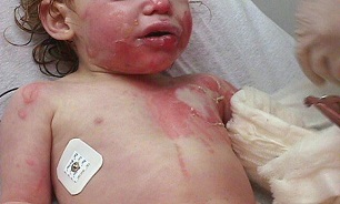کودک سوخته با استفاده از پوست اهدایی از مرگ نجات یافت