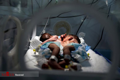 تولد نوزادان بهم چسبیده در یمن.