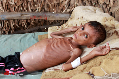 کودک یمنی در سومین سال نسل کشی کودکان در یمن.