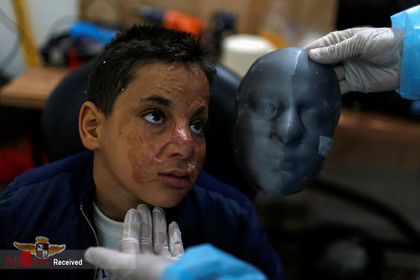 ماسک های سه بعدی برای کودکان غزه که در آتش سوزی سوخته بودند.