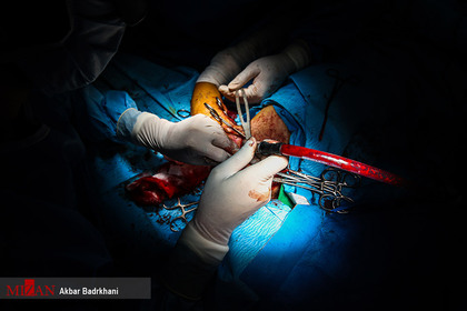 جراحی عصب دست کودک هفت ساله آملی