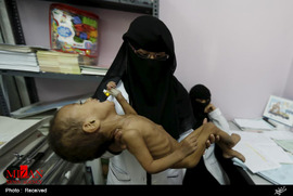 کودکان گرسنه یمن