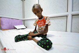 سوءتغذیه در یمن