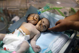 تولد دوقلوهای بهم چسبیده در غزه